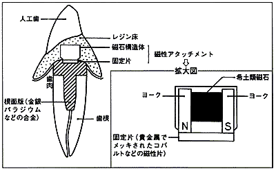 磁石固定式の義歯の構造